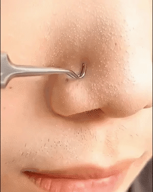 PROFESSIONAL FACIAL BLACKHEAD REMOVER TWEEZER