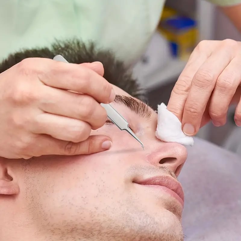 PROFESSIONAL FACIAL BLACKHEAD REMOVER TWEEZER